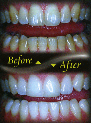 whitening b4 and after